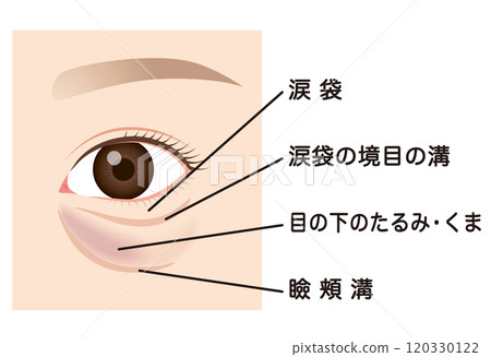 眼袋、下眼瞼下垂 120330122