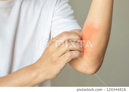 Young asian man itching and scratching on arm from allergic itchy dry skin eczema dermatitis insect bites 120344816