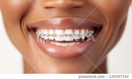 Close-up smile with braces - dental health and confidence concept 120347542