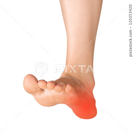 foot with a painful heel, isolated on a white background. Medical concept highlighting injury, foot with a painful heel, isolated on a white background. Medical concept highlighting injury, 120353420
