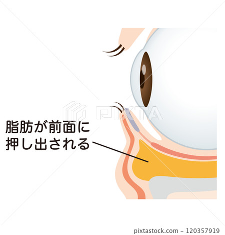 眼袋、下眼瞼下垂 120357919