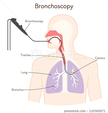 Illustration of lung cancer examination using a bronchoscope, Bronchoscopy 120360071