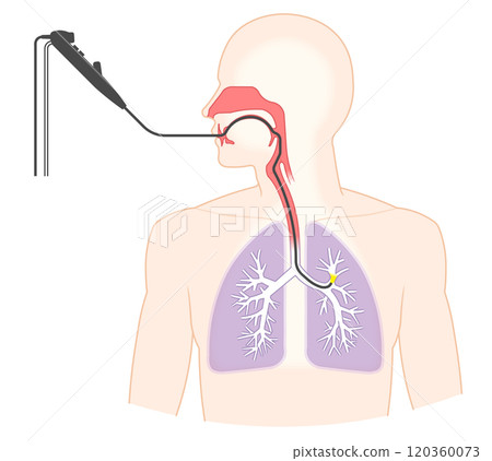 Illustration of lung cancer examination using a bronchoscope, Bronchoscopy Illustration of lung cancer examination using a bronchoscope, Bronchoscopy 120360073