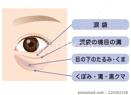 眼袋、下眼瞼下垂 120362236