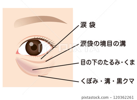Bags under the eyes, sagging lower eyelids 120362261