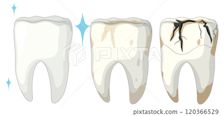 Stages of Tooth Decay Illustration 120366529