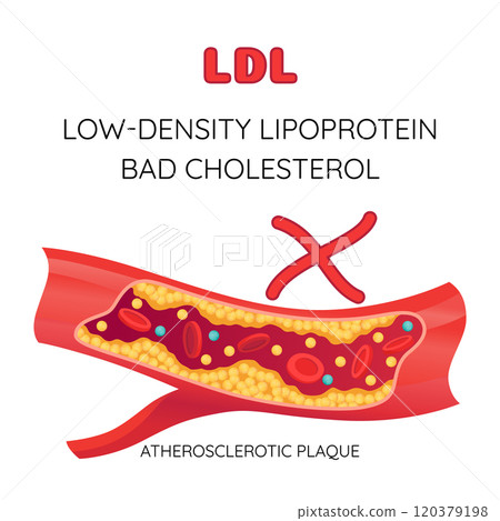 Type of cholesterol in human blood vessels. Narrowed artery for explanation diseases. Low-Density Lipoprotein LDL . Vector illustration 120379198