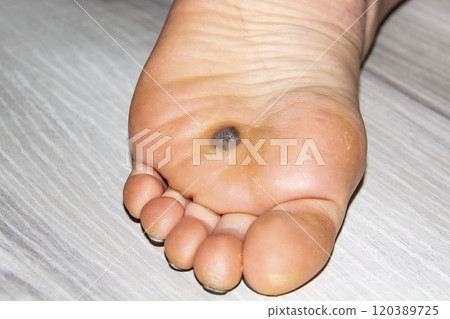 Female leg with a dark space on  Foot after nitrogen freezing plantar wart after three weeks 120389725