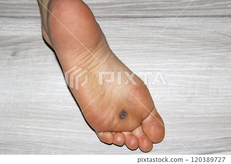 Female leg with a dark space on Foot after nitrogen freezing plantar wart after three weeks Female leg with a dark space on Foot after nitrogen freezing plantar wart after three weeks 120389727