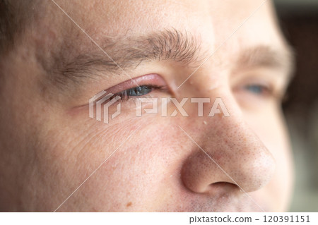Selective focus on swollen and painful red upper eye lid with onset of stye infection due to clogged oil gland and staphylococcal bacteria. Close up right upper eyelid abscess. 120391151