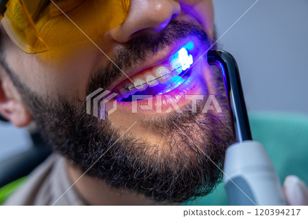 Man in protective glasses having teeth whitening by dental UV whitening device Man in protective glasses having teeth whitening by dental UV whitening device 120394217