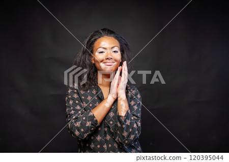 Smiling African Woman with Vitiligo, Hands Near 120395044