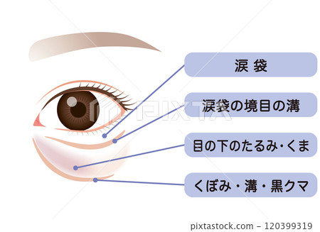 眼袋、下眼瞼下垂 眼袋、下眼瞼下垂 120399319