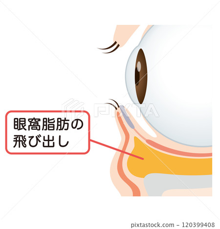 眼袋、下眼瞼下垂 眼袋、下眼瞼下垂 120399408