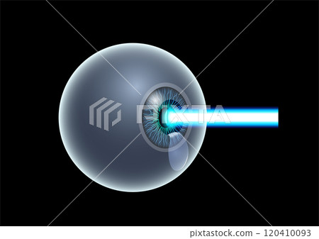 LASIK eye surgery 120410093