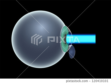 LASIK eye surgery 120410101