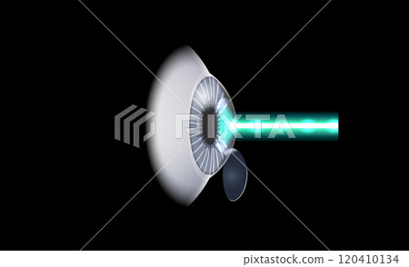 LASIK eye surgery LASIK eye surgery 120410134