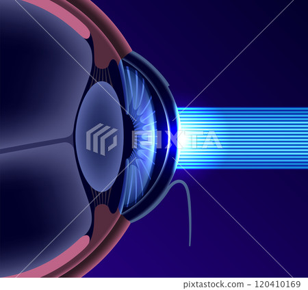 LASIK eye surgery LASIK eye surgery 120410169