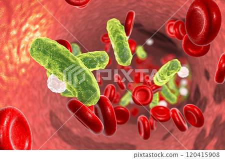 Sepsis, bacteria in blood 120415908