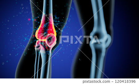 Inflamed Human Knee Joint: A Detailed Anatomical Illustration 120418396