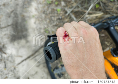 Bike rider hand injury with red blood from hitting a tree stump. Mountain biking accident Bike rider hand injury with red blood from hitting a tree stump. Mountain biking accident 120423248