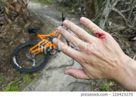 Arm injury while riding mountain bike on Florida jungle trails. Red bloody wound from hitting a tree stump. Biking accident 120423270