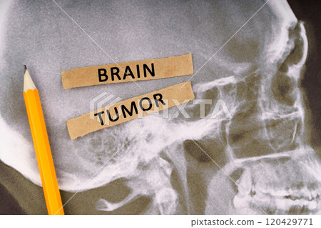On x-rays of a human skull, a pencil and strips of paper with the inscription - Brain tumor 120429771