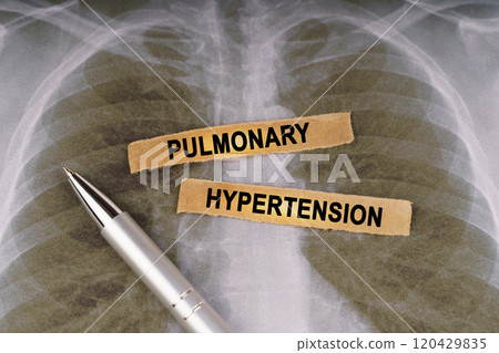 On a human chest x-ray, a pen and strips of paper labeled - Pulmonary hypertension 120429835