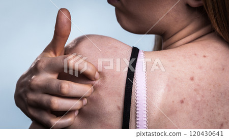 Woman with skin problem acne on back 120430641