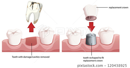 Dental Crown Replacement Process Illustration 120438925