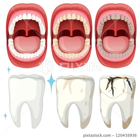 Dental Health and Tooth Decay Stages 120438936