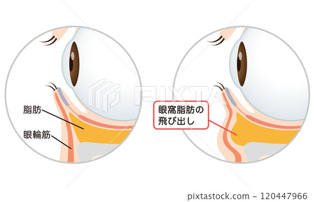 Sagging under the eyes: Firm eyes and sagging eyes Sagging under the eyes: Firm eyes and sagging eyes 120447966