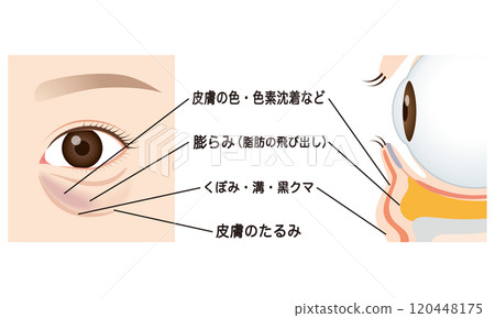 Bags under the eyes, sagging lower eyelids 120448175