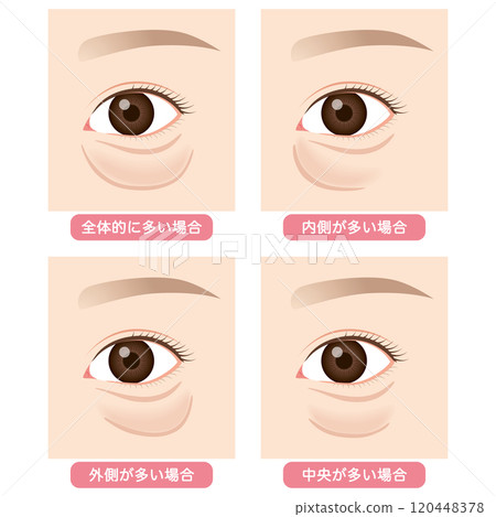 眼袋、下眼瞼下垂型 眼袋、下眼瞼下垂型 120448378