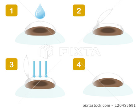 Illustration showing the procedure for vision correction surgery Illustration showing the procedure for vision correction surgery 120453691