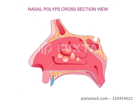 Nasal Polyps Cross-Section Diagram: Medical Illustration of Nasal Cavity with Polyps for Educational and Clinical Use 120454022