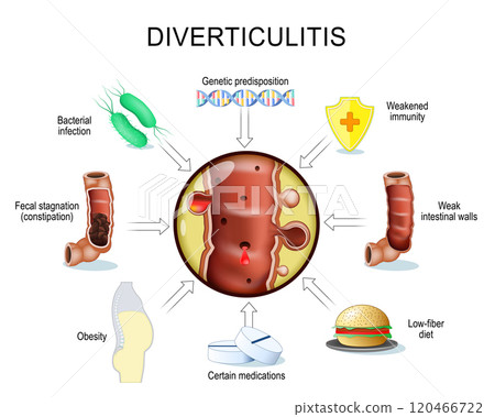 diverticulitis progression 120466722