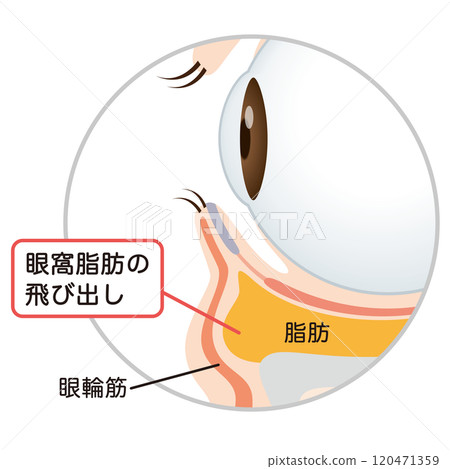 眼袋、下眼瞼下垂 120471359