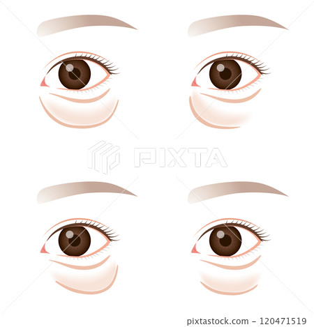 Sagging under the eyes, sagging lower eyelid type Sagging under the eyes, sagging lower eyelid type 120471519