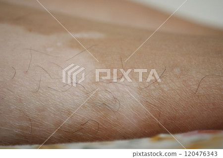 feet with vitiligo skin condition. feet with vitiligo skin condition. 120476343