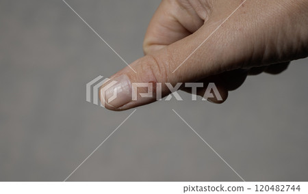 there is a fresh wound on the thumb 120482744