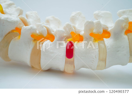 Spinal nerve and bone, Lumbar spine displaced herniated disc fragment, Model for treatment medical in the orthopedic department. 120490377
