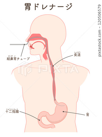 胃引流、鼻胃管 120506579