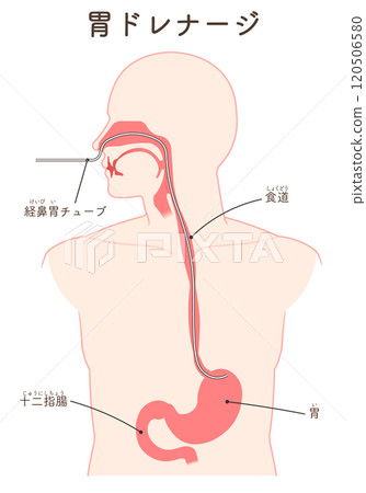 Gastric drainage, nasogastric tube Gastric drainage, nasogastric tube 120506580