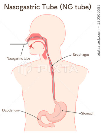 Gastric drainage, nasogastric tube 120506583