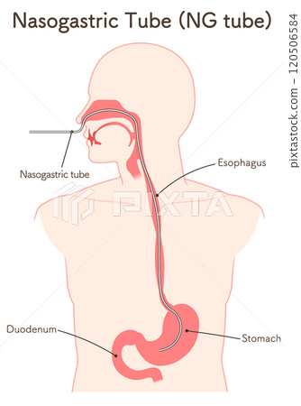 Gastric drainage, nasogastric tube 120506584