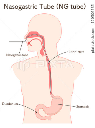 Gastric drainage, nasogastric tube 120506585