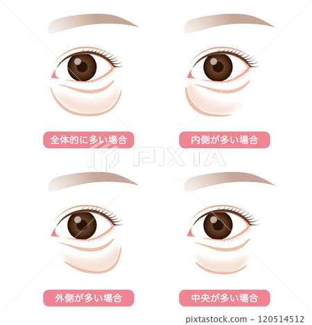 Sagging under the eyes, sagging lower eyelid type Sagging under the eyes, sagging lower eyelid type 120514512