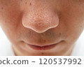 Strawberry nose close-up: pores and blackheads of a man in his 30s 120537992