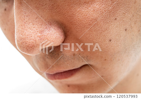 Strawberry nose close-up: pores and blackheads of a man in his 30s 120537993